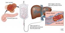 Islet cell transplant