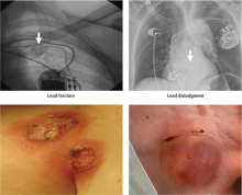 Common transvenous pacemaker lead and pocket-related complications