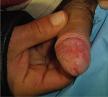 Circinate balanitis