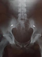 Grade 3 bilateral sacroiliitis