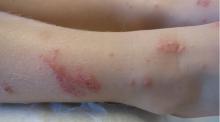 Bedbug bites