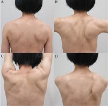 Scapular appearances at 0 degrees of shoulder abduction, 90 degrees of shoulder abduction, 180 degrees of shoulder forward elevation, and 90 degrees of shoulder forward flexion.