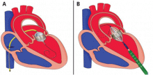 Routes of transcatheter mitral valve replacement