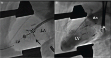 Transatrial implantation of the NaviGate transcatheter mitral valve replacement prosthesis