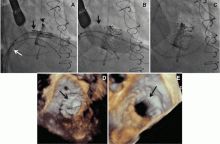 Transfemoral mitral valve-in-valve replacement of a balloon-expandable valve