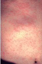 Measles