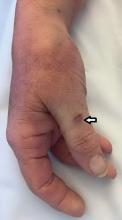 laceration (arrow) on patient’s right thumb from a dog bite