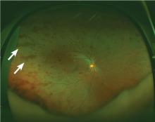 Peripheral retinal hemorrhage