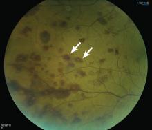 Roth spots