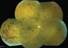 Multiple Roth spots