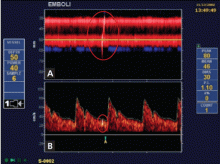 Embolic signal on transcranial Doppler ultrasonography