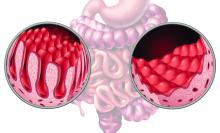 Celiac or coeliac intestine disease anatomy medical concept with normal villi and damaged small bowel lining as an autoimmune disorder of the digestion system with colon and stomach as a 3D illustration.