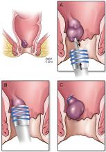 Figure 2. In rubber band ligation, an internal hemorrhoid is grasped with a forceps (A) and drawn into the cylinder of the ligator (B). A band is deployed around the base of the hemorrhoid (C), cutting off its blood supply and causing it to fall off withi