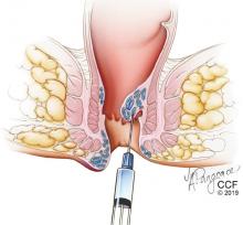 Figure 3. Sclerotherapy involves injecting an irritating solution into the hemorrhoid, reducing its blood supply and causing it to shrink.