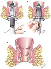 Figure 4. In stapled hemorrhoidopexy, a special tool is inserted (A). Excess tissue is excised (B), and the remaining tissue is drawn up to its normal position and fastened in place, yielding the result pictured in panel C.