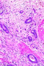 A tumor budding in colorectal carcinoma is shown here.