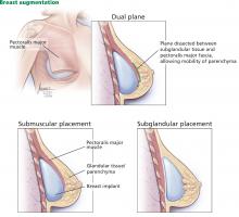 Placement of breast implants.