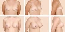 The images in the top row are before breast augmentation. Those in the bottom row are 7 months after breast augmentation surgery with 350-cc smooth, round silicone breast implants.