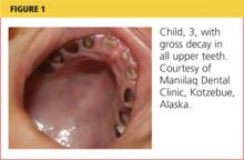 Child, 3, with gross decay in all upper teeth image