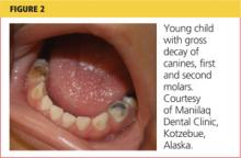 Young child with gross decay of canines, first and second molars image