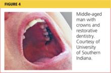 Middle-aged man with crowns and restorative dentistry image