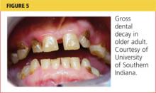 Gross dental decay in older adult image