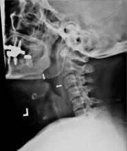 Figure 1. Enlarged epiglottis (arrows) visible on lateral neck radiography.