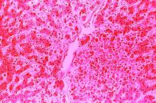 This hematoxylin-eosin-stained photomicrograph depicts the cytoarchitectural changes found in a liver tissue specimen extracted from a dengue hemorrhagic fever patient.