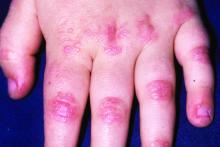 dermatomyositis on child's hand