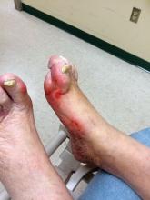 Diabetic foot