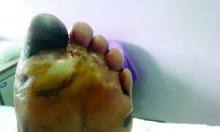 https://commons.wikimedia.org/wiki/File:Diabetic_foot_ulcer_(4199686300).jpg