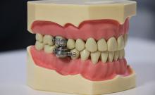 Dental device for weight loss keeps mouth almost closed