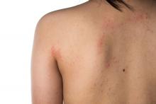 eczema on the back