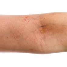 Eczema on a person's arm