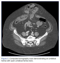 Failure to Reduce: Small Bowel Obstruction Hidden Within a Chronic ...