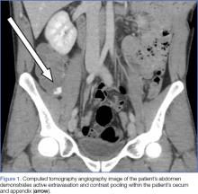 CT angiography of the abdomen