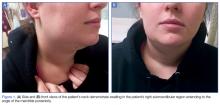 Side and front views of the patient's neck demonstrate swelling in the right submandibular region