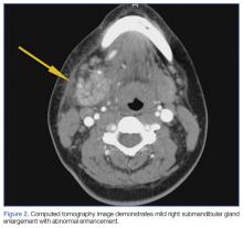 CT image demonstrates mild right submandibular gland enlargement