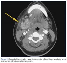 CT images demonstrates mild right submandibular gland enlargement