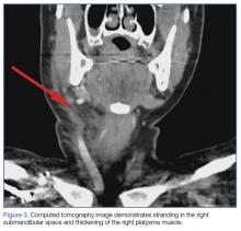 CT image demonstrates stranding in the right submandibular space