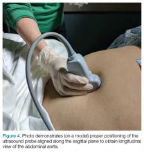 Longitudinal view of the abdominal aorta