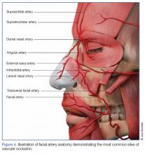 Illustration of facial artery anatomy demonstrating the most common sites of vascular occlusion