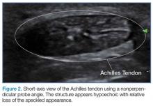 Short-axis view of the Achilles tendon using a nonperpendicular probe angle.