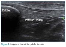 Long-axis view of the patellar tendon.