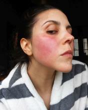 Persistent erythema in a woman with rosacea.