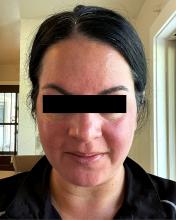 Persistent erythema in a patient with rosacea