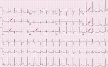  Figure 1. The patient’s electrocardiogram on presentation shows ST-segment elevation (arrows) over the lateral and inferior distribution (V4–V6, II, III, and aVF). 