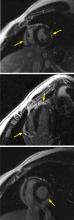 Figure 2. Cardiac magnetic resonance imaging shows areas of patchy subepicardial late gadolinium enhancement (arrows).