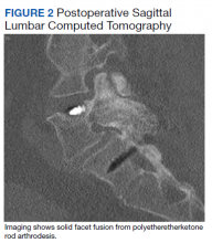 Postoperative Sagittal Lumbar Computed Tomography figure