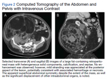 Computed Tomography of the Abdomen and Pelvis with Intravenous Contrast